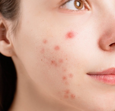 A young woman with adult acne on her cheeks.