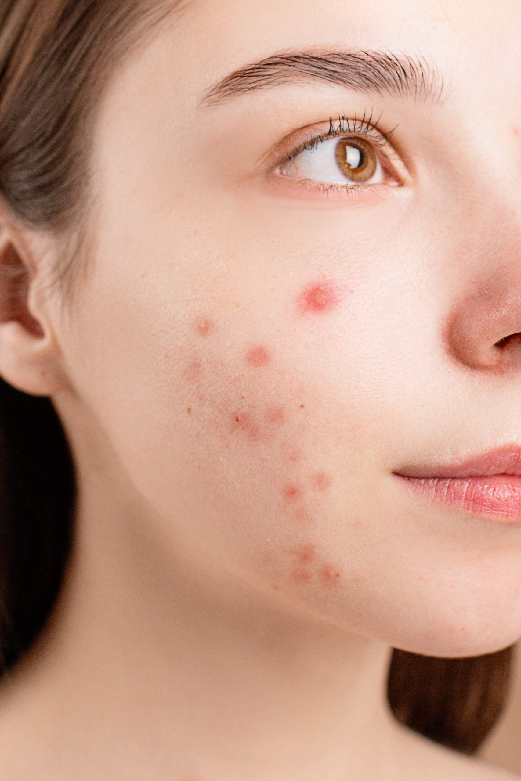 A young woman with adult acne on her cheeks.